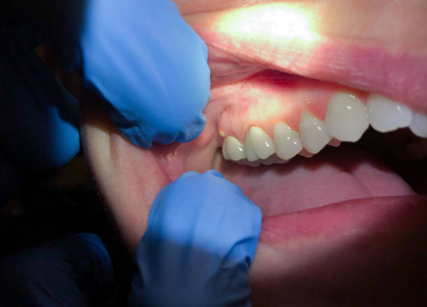 Best Emergency Wisdom Teeth Removal in Al Creek, CO